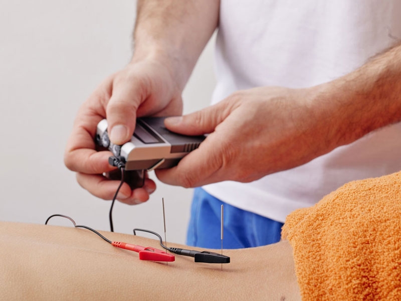 Dry Needling: trattamento del dolore miofasciale e delle tensioni muscolari