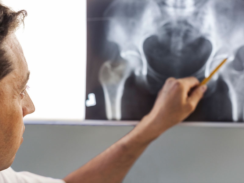 Riabilitazione della protesi d’anca: il ruolo fondamentale della fisioterapia